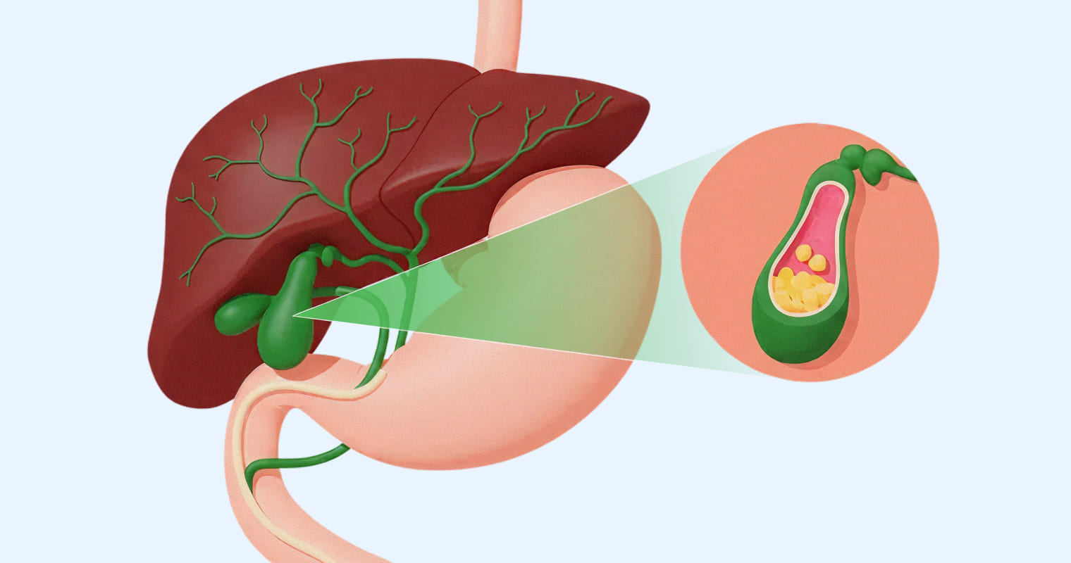 Лапароскопическая холецистэктомия: современный подход к удалению желчного пузыря