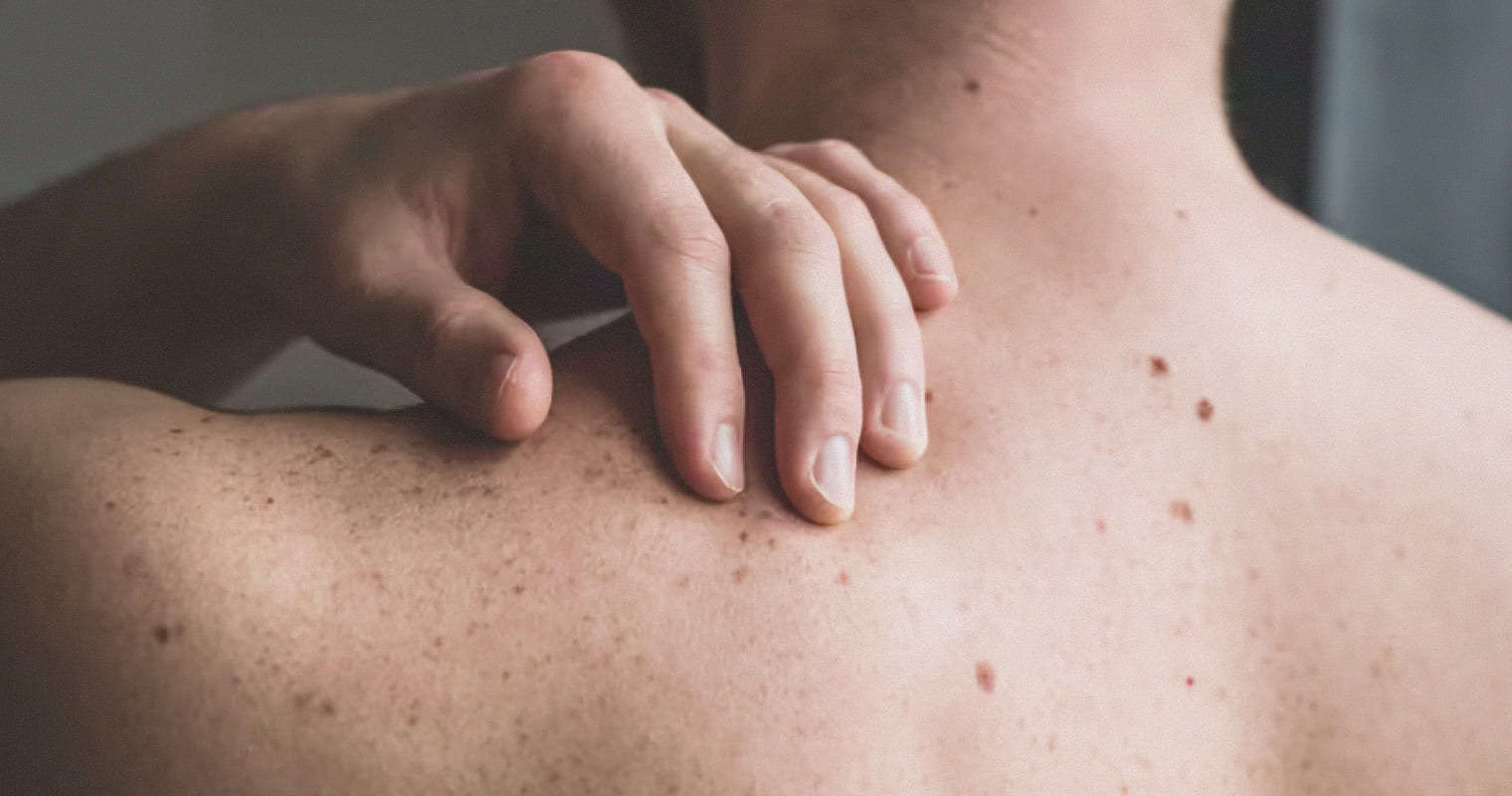 Рак кожи: как распознать первые признаки и что делать дальше