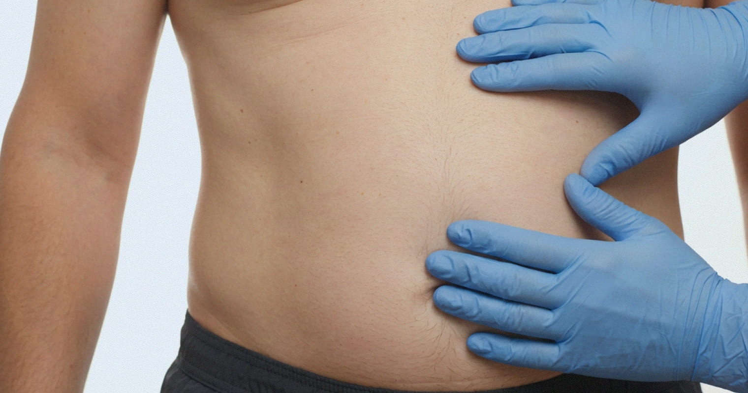 Грыжи живота: виды, риски и современные методы герниопластики